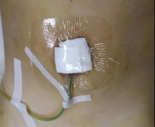 这台尖端手术让我省小儿普外科水平跻身全国前列