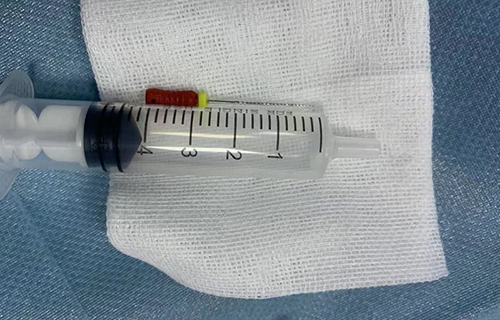 4岁女宝胃里竟有1根4厘米长针