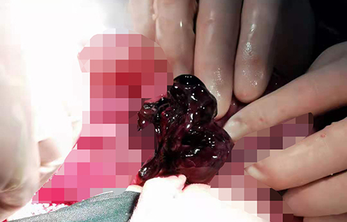 肠管变暗紫色！这病2岁宝宝最易得