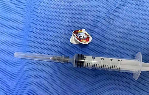 神速！医生秒取异物，这玩意咋卡进去的呢？