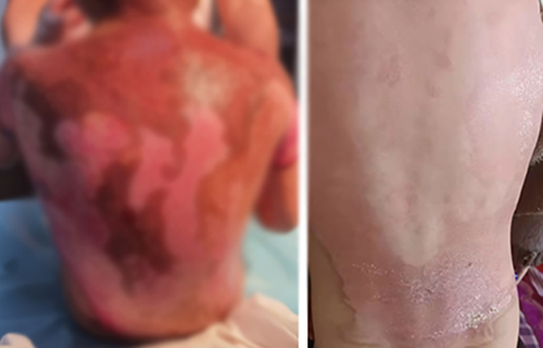 快过年了，5岁男孩掉进开水锅重度烫伤