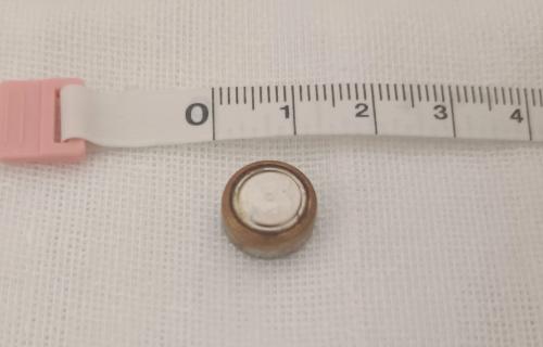 扎心！长春20月龄男孩竟将纽扣电池塞进眼内