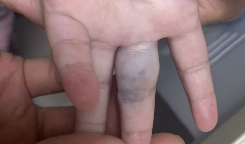 别让血管畸形给孩子的童年留下阴影