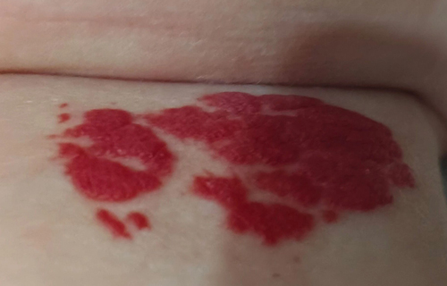 抹去“天使之吻”，别让宝宝“瘤”下遗憾