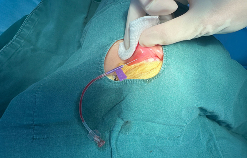 不开刀的血管焕新术：蜜桃视频
DSA技术开启微创介入治疗新纪元