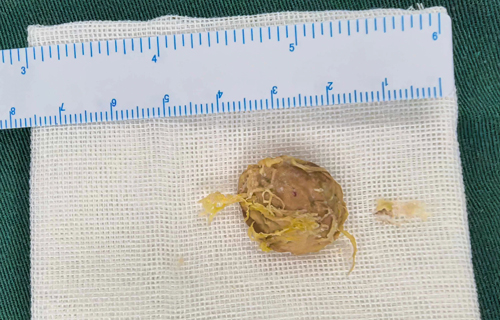 半块桃核让内蒙古患儿紧急来长，儿医10分钟除“真凶”