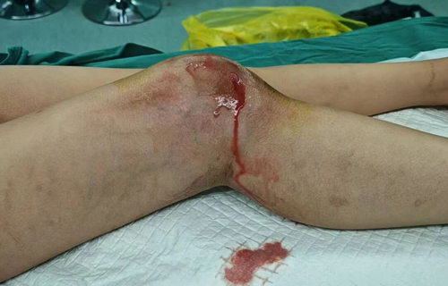 7岁男童延误治疗险致残，化脓性关节炎早治疗很关键